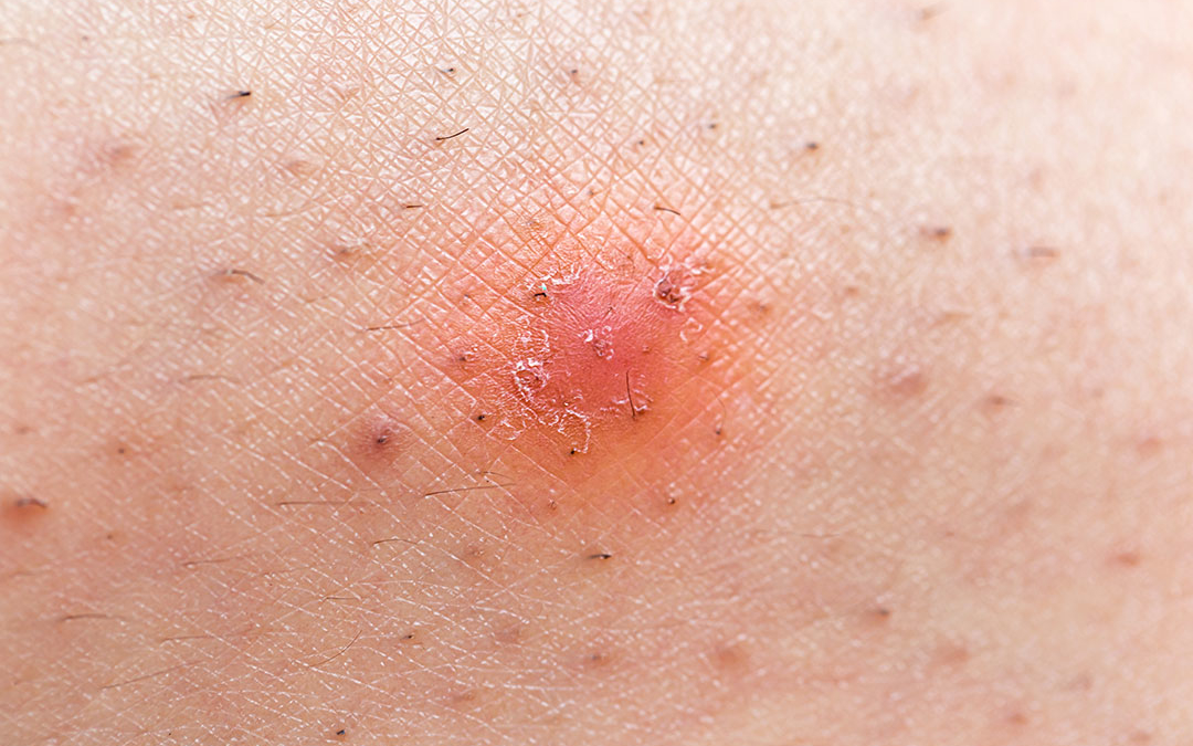 Rekomendasi Produk untuk Mengatasi Ingrown Hair yang Paling Ampuh | Jasa Maklon Hair Care Terbaik dan Terpercaya di Jakarta dan Tangerang | Sinar Alfa Omegax